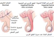 علاج الفتق الاربي عند الرجال والنساء مجرب ومضمون - المستقبل نيوز