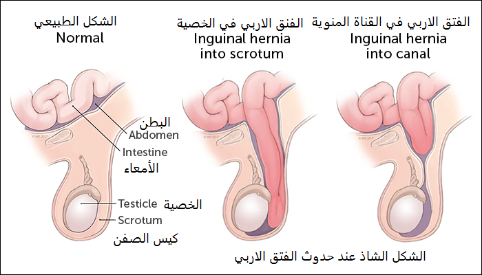 علاج الفتق الاربي عند الرجال والنساء مجرب ومضمون المستقبل