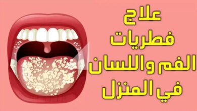 كيفية علاج فطريات اللسان بالأعشاب