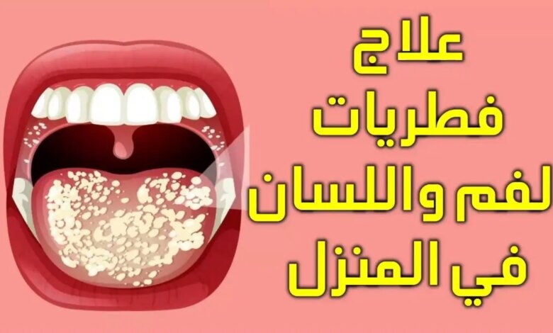 كيفية علاج فطريات اللسان بالأعشاب