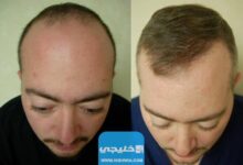 أفضل عيادة لزراعة الشعر في الكويت 2023