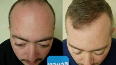 أفضل عيادة لزراعة الشعر في الكويت 2023