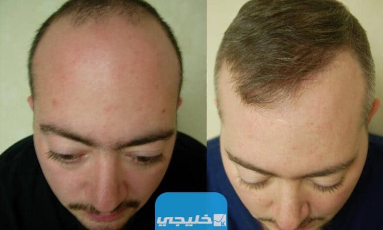 أفضل عيادة لزراعة الشعر في الكويت 2023