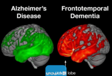 ما هو مرض الخرف الجبهي الصدغي الذي اصيب الممثل بروس